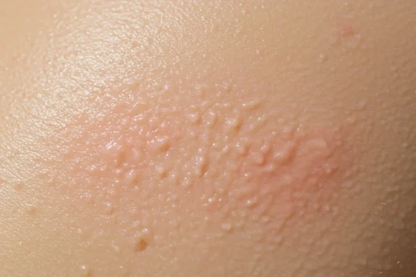 Fragrance-Free Fails: 2026 Skin Irritation Crisis