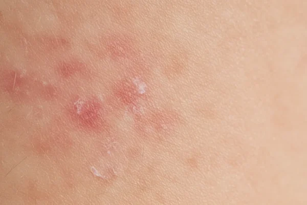 Rosacea & Eczema: 5 Steps to 2026 Skin Health